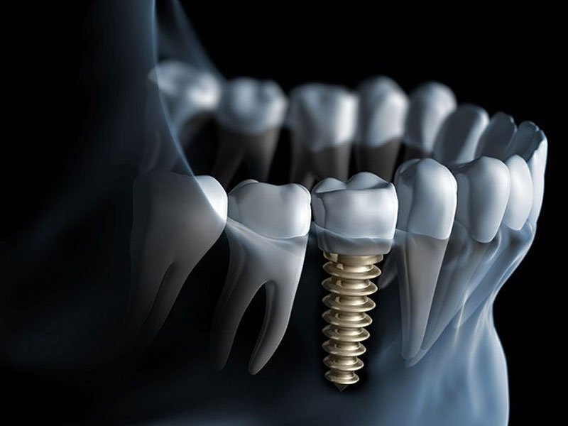 Implantes dentales