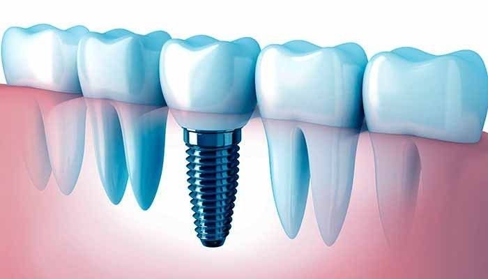 Implantes dentales