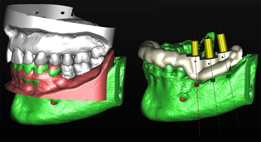 implantología 3d