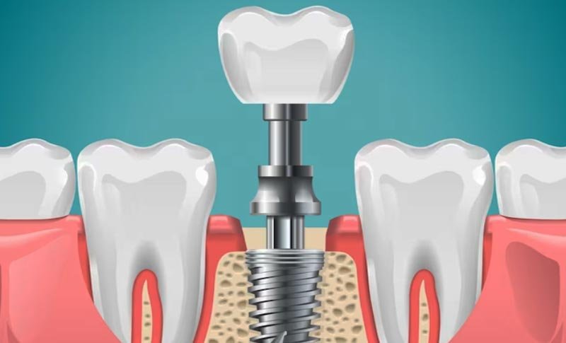 duracion de los implantes dentales