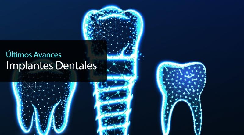 últimos avances en implantes dentales